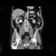 Complicated cyst, Bosniak III: CT - Computed tomography